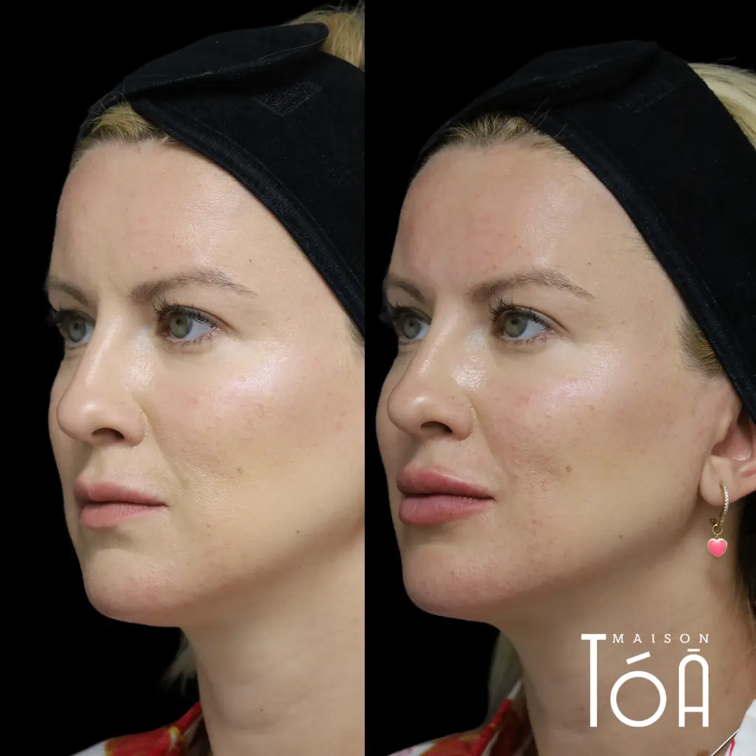 acide hyaluronique lèvres