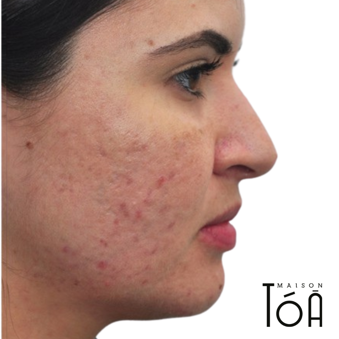 microneedling