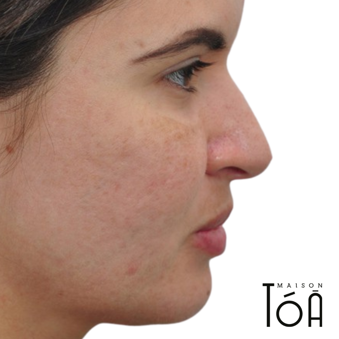 Microneedling