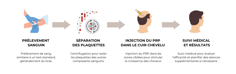 étapes prp cheveux