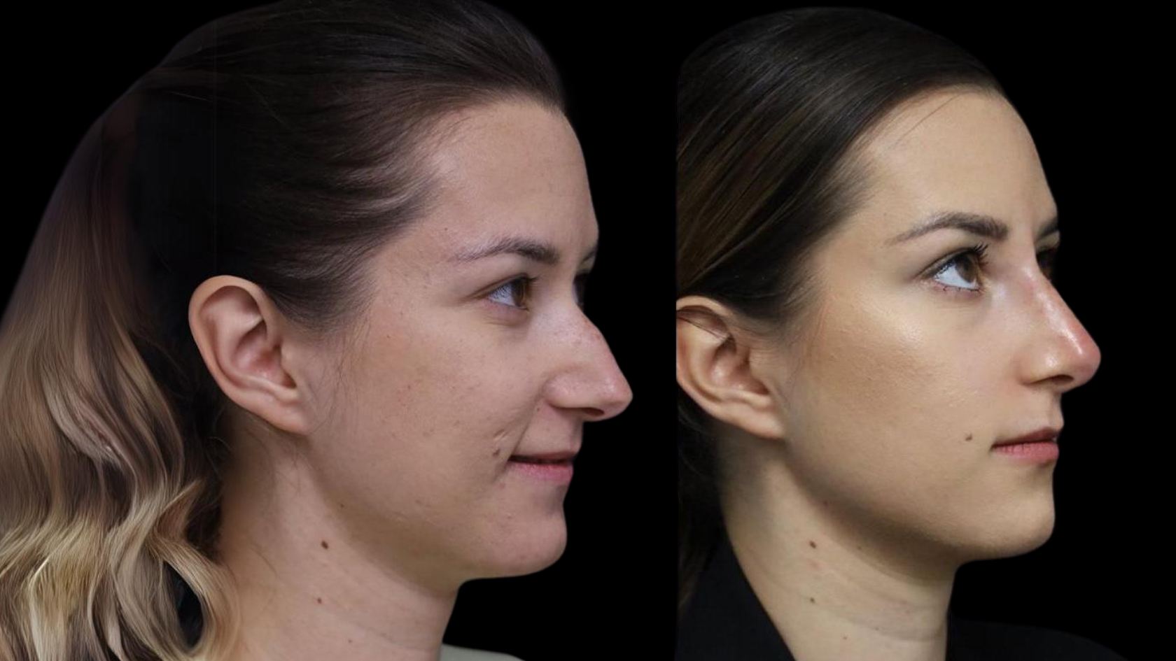 acide hyaluronique nez