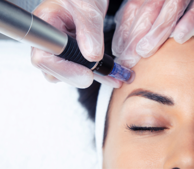 microneedling