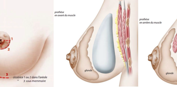 augmentation mammaire devant ou derriere le muscle
