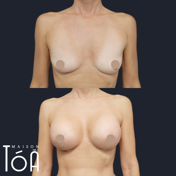 AUGMENTATION MAMMAIRE Lausanne