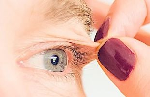 Blépharoplastie Lausanne