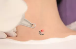 détatouage