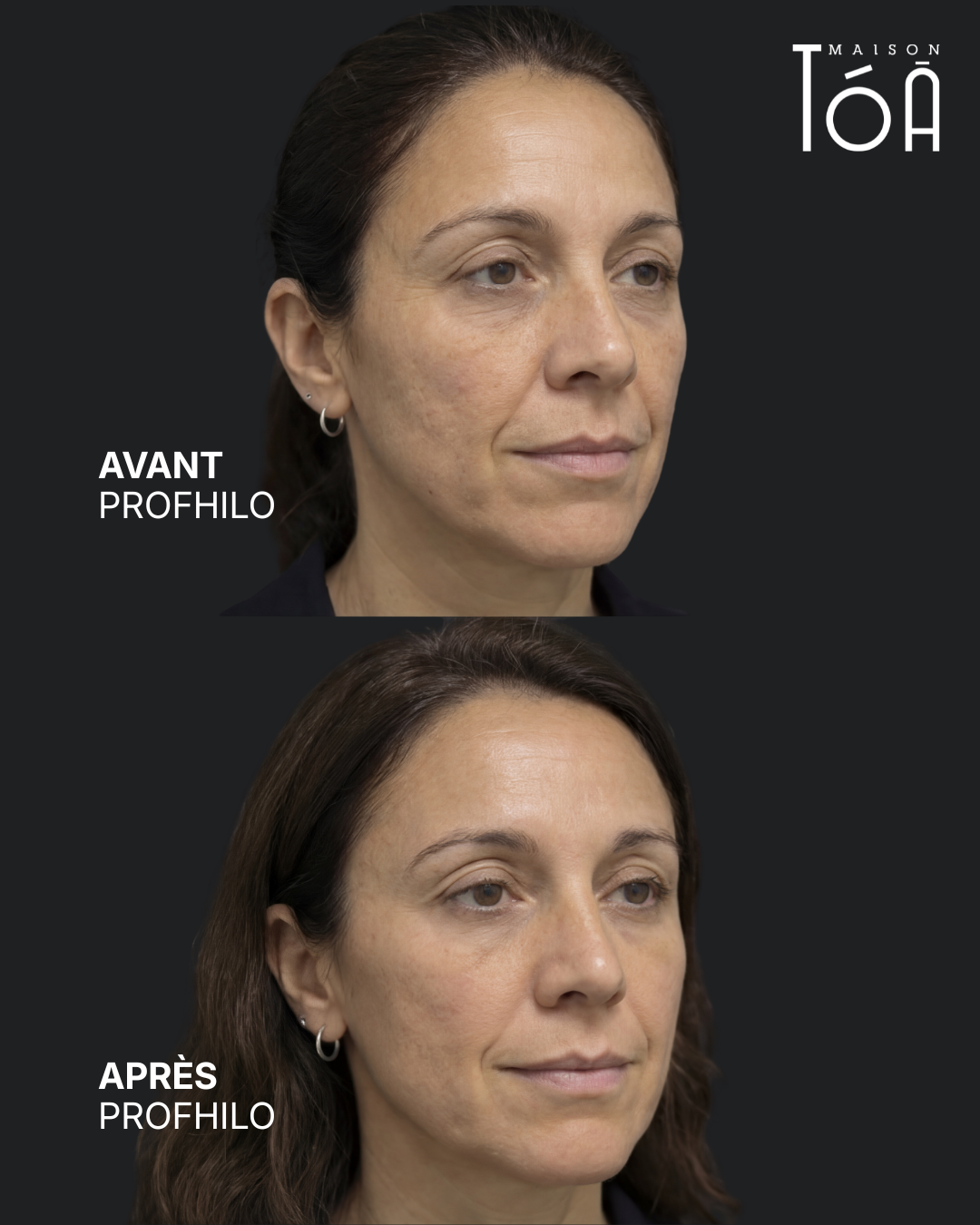 Avant Après profhilo
