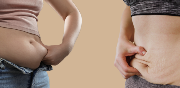 Liposuccion vs abdominoplastie