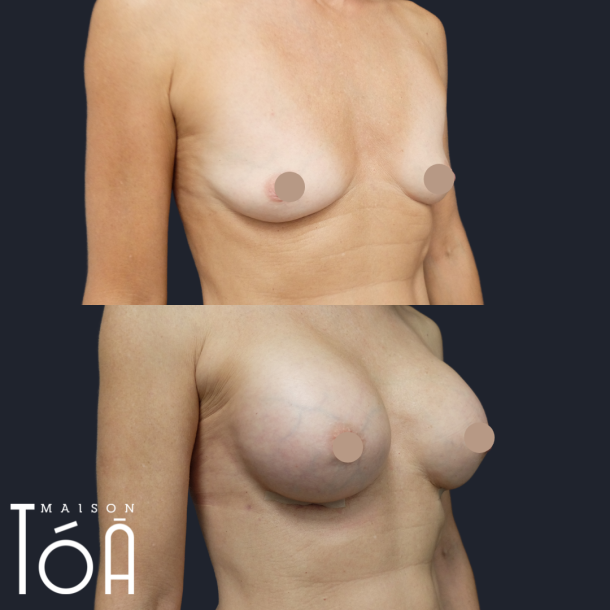 AUGMENTATION MAMMAIRE