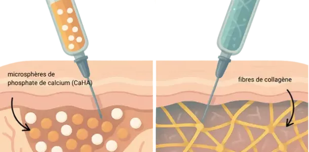 Sculptra vs radiesse